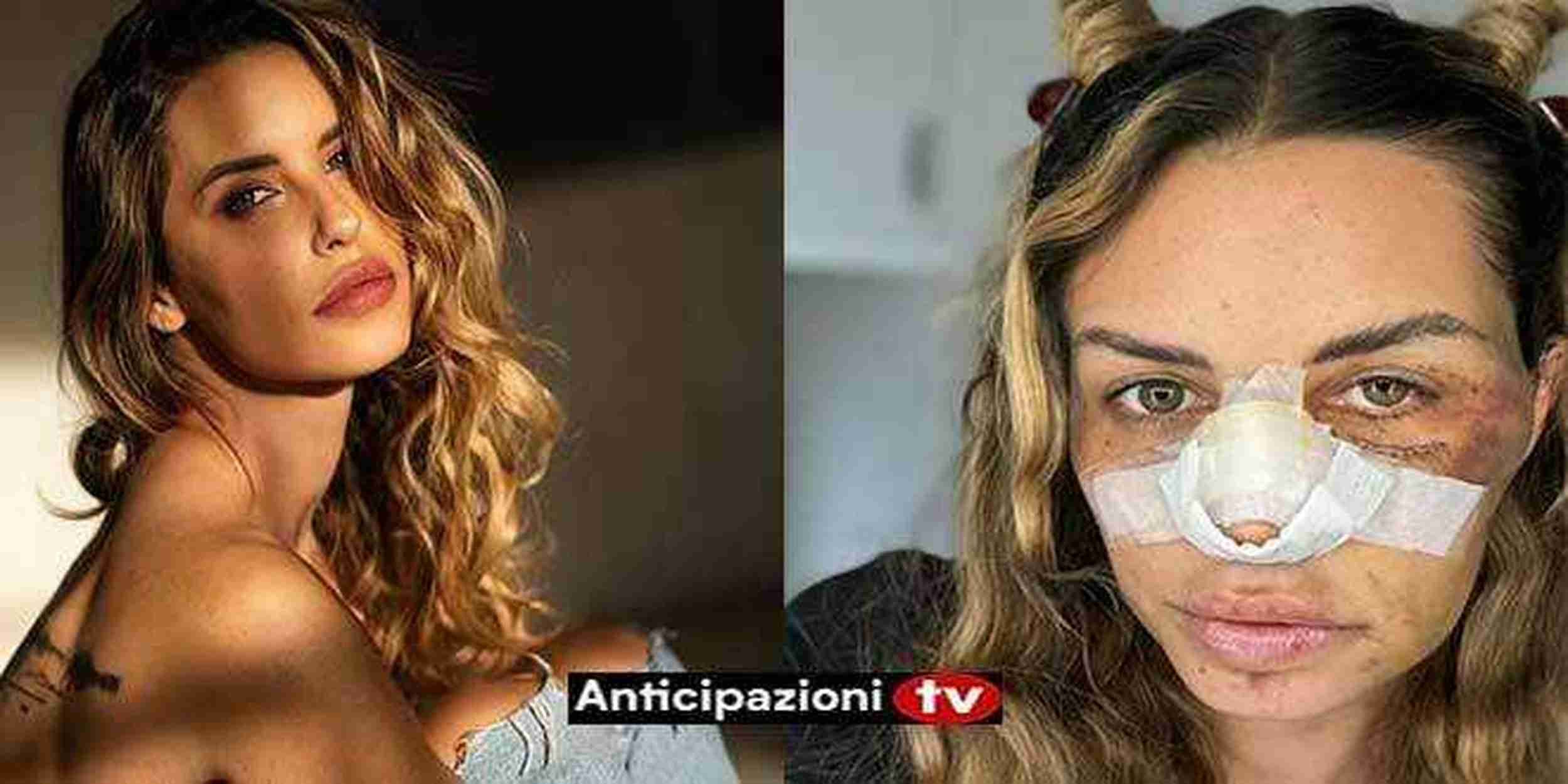 Temptation Island, Carlotta Adacher si mostra per la prima volta dopo il grave incidente stradale