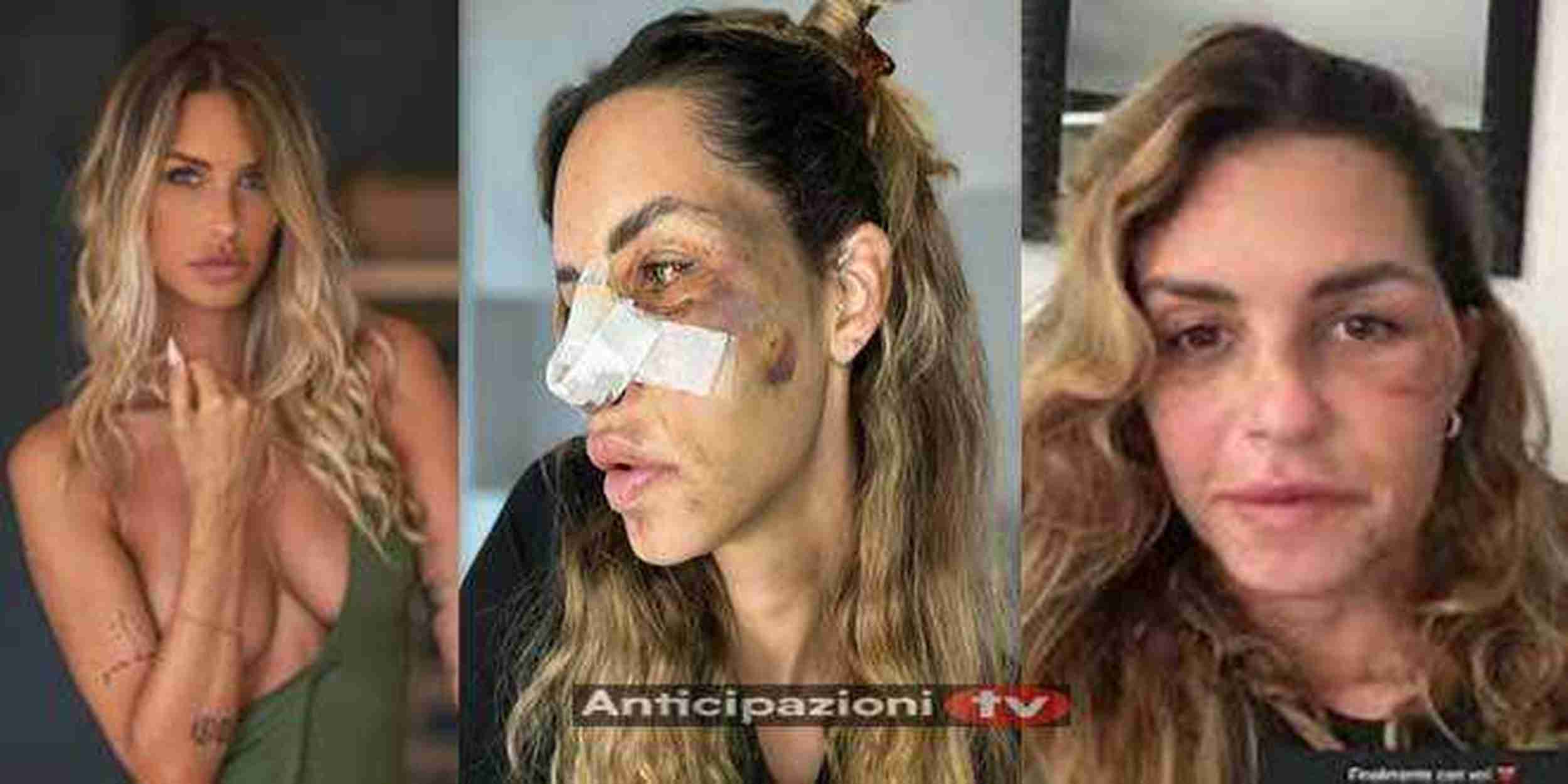 Temptation Island, Carlotta Adacher insultata dopo la chirurgia: “Sei un mostro!”