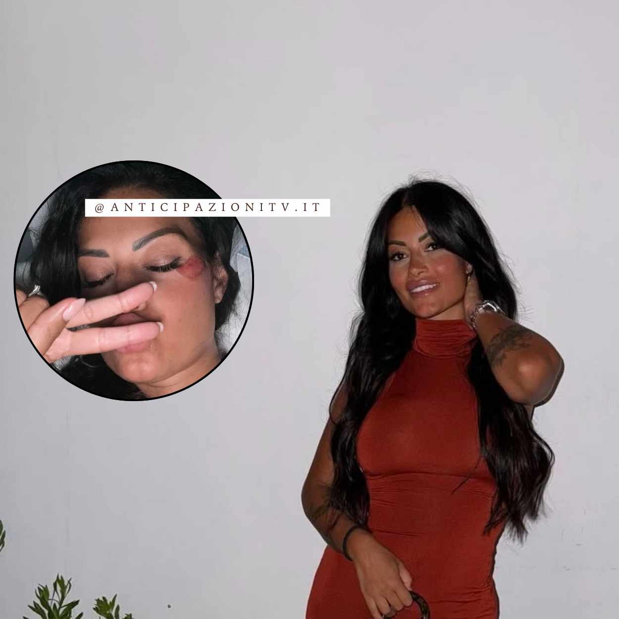 Alessia Pascarella con livido sotto l’occhio dopo l’incidente