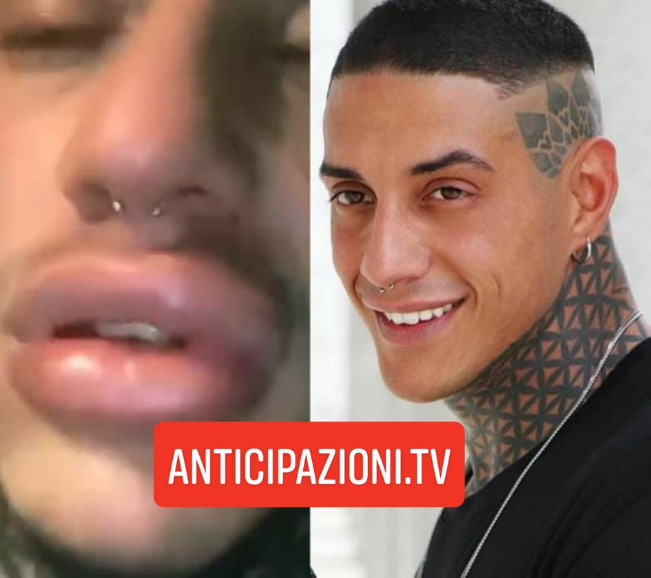 Francesco Chiofalo: le labbra si sono gonfiate a causa del botox? Ecco come sta ora