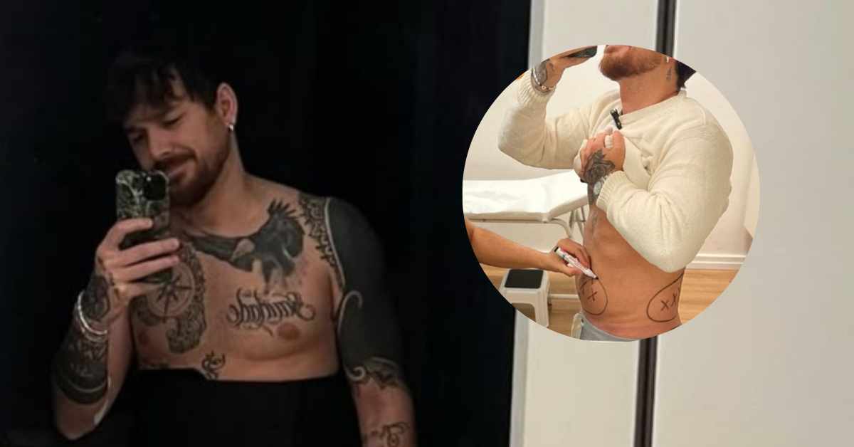 Andrea Cerioli parla dopo la mini-liposuzione